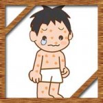 子供が水疱瘡に!保育園の登園許可はいつから?休む期間は何日か