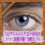 白目がぶよぶよ充血の原因はコンタクトに結膜浮腫?治療法について