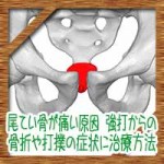 尾てい骨が痛い原因!強打からの骨折や打撲の症状に治療方法について